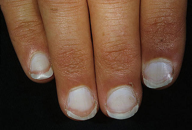 Білі нігті, майже молочного кольору можуть виникати при ураженні наднирників і формуванні Аддісона хвороба