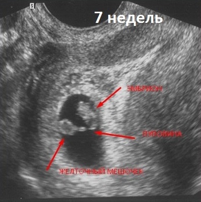 Ембріон міцно з'єднаний пуповиною зі стінкою матки