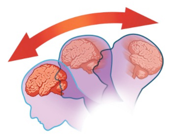 Струс мозку відбувається тільки при агресивному механічному впливі на голову - наприклад, таке може трапитися при падінні людини і ударі головою об підлогу