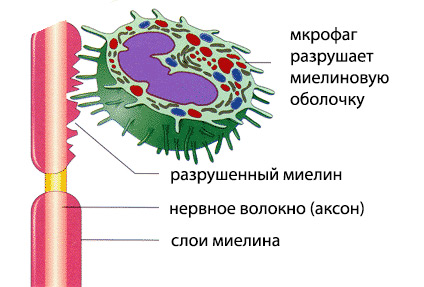 Причини і механізми демиелинизации