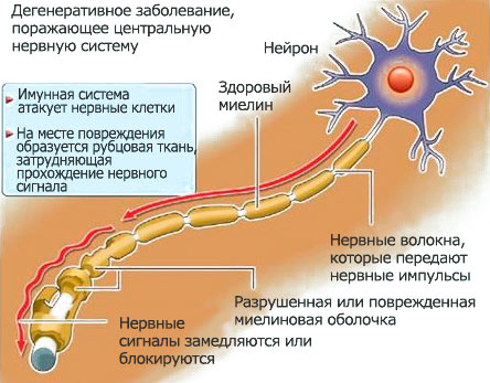 У цій стадії з'являється стійкий і необоротний неврологічний дефіцит