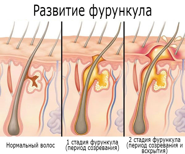 Розвиток фурункула відбувається в 3 стадії, тривалість яких при відсутності ускладнень становить до 10 днів: