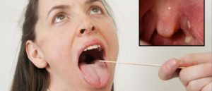 Якщо виявлено мікоз горла у дитини або дорослого, то прогноз при своєчасному зверненні до лікаря - сприятливий