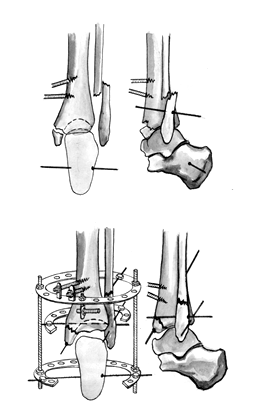 Вид перелому і схема чрескостного остеосинтезу апаратом зовнішньої фіксації при переломах кісточок і заднього краю великогомілкової кістки