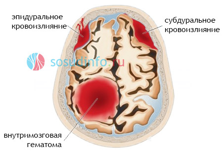 Плазматичного просочування стінок судин белового мозкової речовини або зорових горбів;   Диапедезного кровотечі;   Освіти микроаневризм