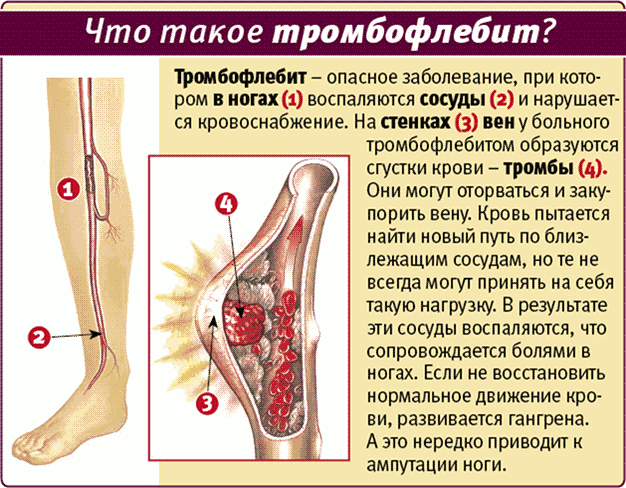 Початкові стадії захворювання виражені досить слабо і називаються флеботромбозом, оскільки не супроводжуються запаленням судин