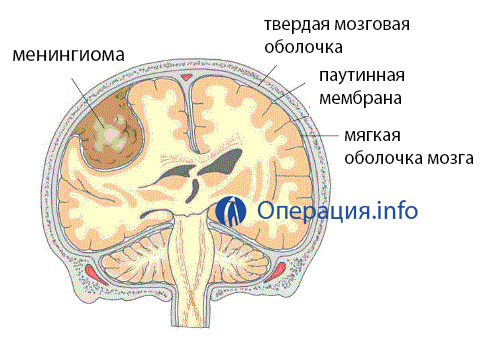 Менінгіома - це одна з найбільш частих доброякісних пухлин м'якої мозкової оболонки