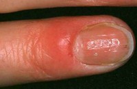 Для того щоб попередити або вилікувати захворювання шкіри навколо нігтя, треба дотримуватися таких правил:
