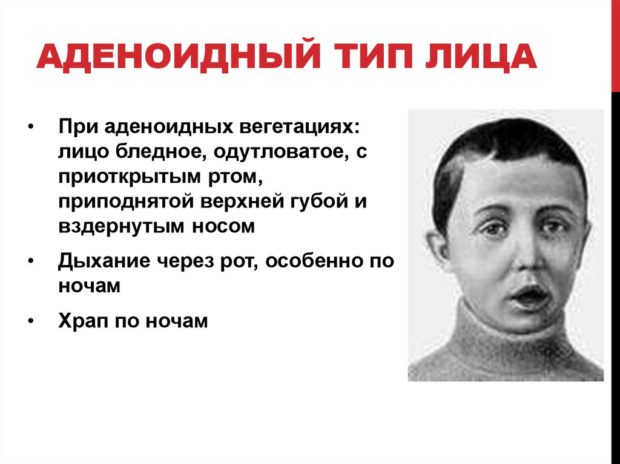 Нерідко приєднується ексудативний (з виділеннями) середній отит, але дитина при цьому не завжди скаржиться на болі в вухах або зниження слуху