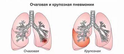 Крупозна пневмонія протікає з найяскравішими ознаками