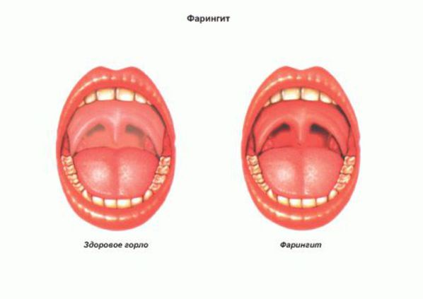 Фарингіт небезпечний своїми ускладненнями, серед яких найбільш грізними є ревматичні ураження суглобів і серця