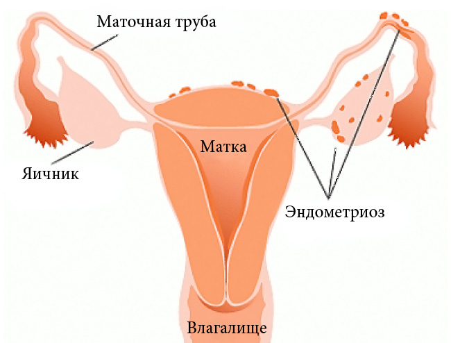 Цей факт може стати причиною безпліддя