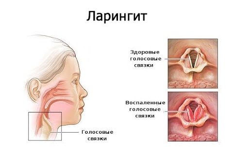 Ларингіт - запальний процес в гортані