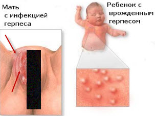 Герпес другого типу
