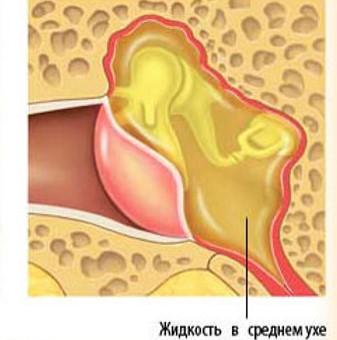 Середній отит - найбільш поширена форма захворювання, що супроводжується накопиченням ексудативної рідини в порожнині, що знаходиться за барабанною перетинкою