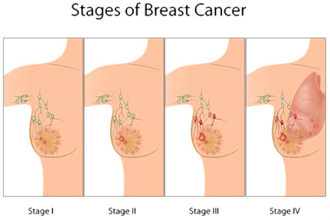Додатково призначається препарат Зомета, що підвищує щільність кісткових тканин