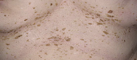 Це перша ознака, за яким можна відрізнити родимі плями від таких утворень