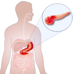 Для хворих панкреатитом потрібна особлива дієта, підшлункова залоза безпосередньо бере участь у травленні
