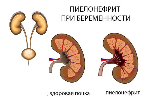 Пієлонефрит - запальний процес, що розвивається в нирках і вражає спочатку їх інтерстиціальну тканину, а потім чашечки і миски