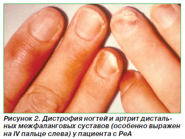Рідко можуть спостерігатися виразки рогівки і кератит, були описані оптичний неврит і задній увеїт