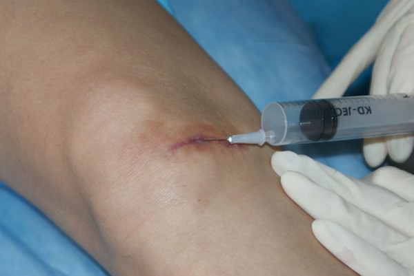 Ін'єкції проти шрамів