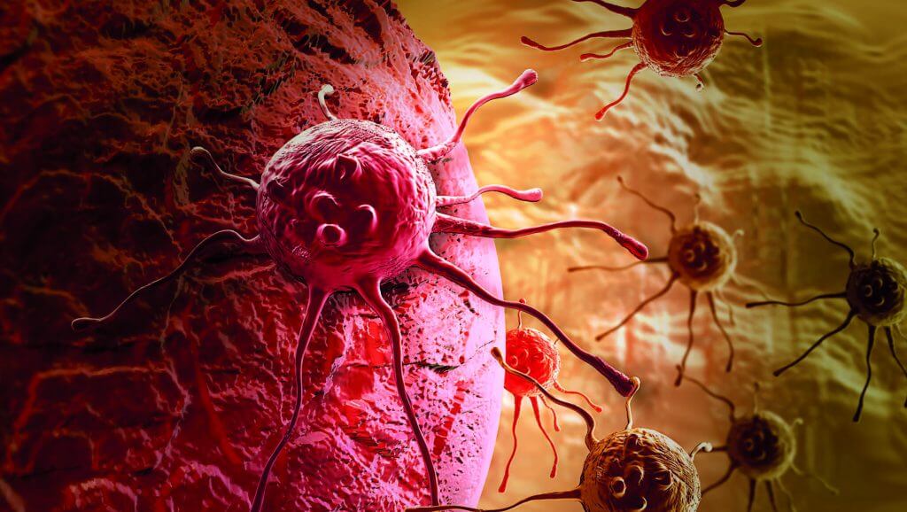 Однак в Україні цей діагноз сприймають як трагедію не тільки через його поширеності, але і через відсутність узгодженої системи ранньої профілактики і недоступності сучасного лікування