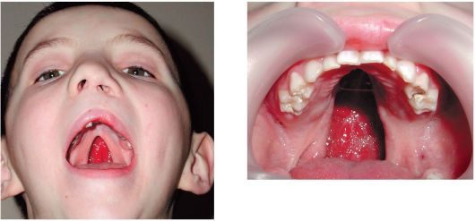 У дівчаток ця патологія зустрічається в 2 рази частіше