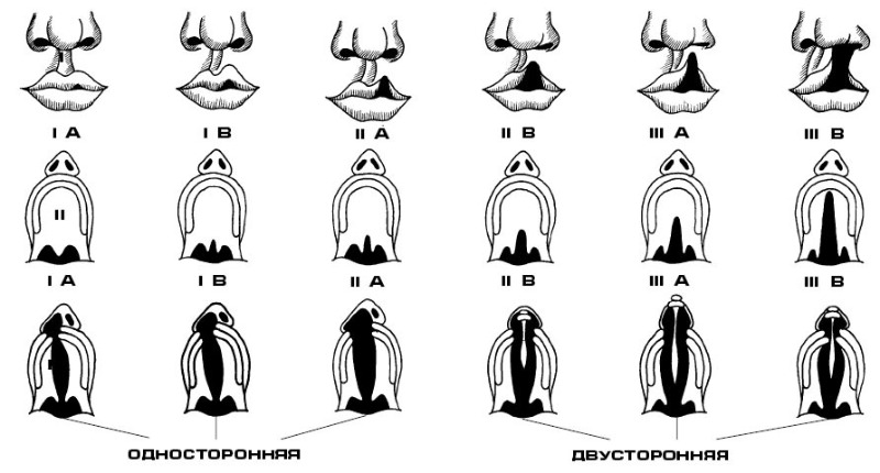 Незарощення тільки м'якого піднебіння;   Одночасне незарощення м'якого піднебіння, частини твердого;   Повний незарощення твердого та м'якого піднебіння з одного боку;   Повний незарощення твердого та м'якого піднебіння з двох сторін