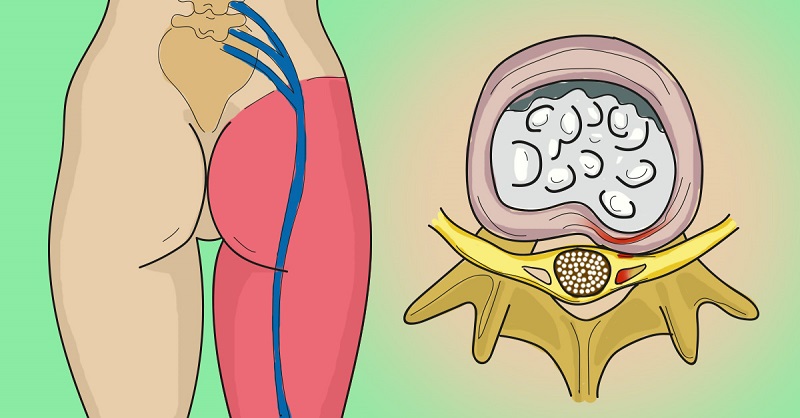 Защемлення сідничного нерва